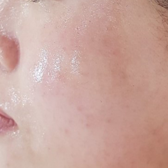 시술 후